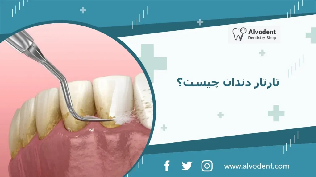 تارتار دندان