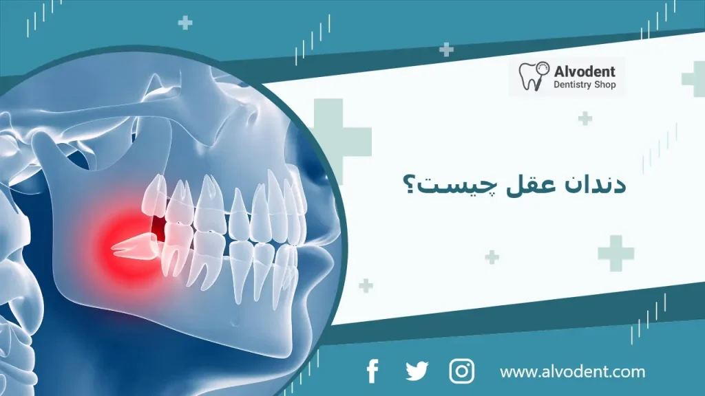 دندان عقل